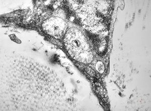 M, 10y. | Coffin-Lowry syndrome